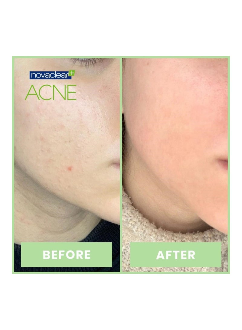 novaclear Acne Kit With Acne Facial Foam 100ml + Acne Toner 150ml + Acne Cream For Oily, Combination And Acne-Prone Skin 40ml - Image 4
