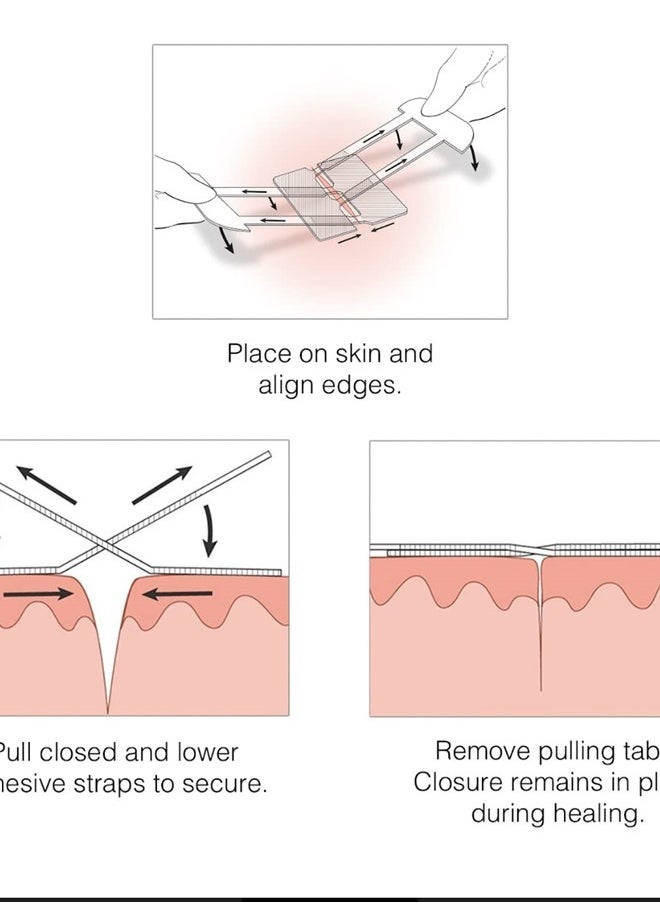 Clozex - Emergency Laceration Closures - Repair Wounds Without Stitches. FDA Cleared Skin Closure Device for 3 Individual Wounds Or Combine for Total Length of 4 1/4 Inches. - Image 1