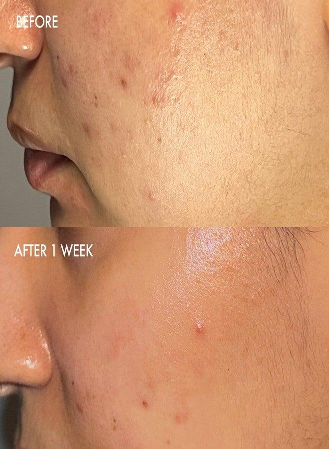 Dermisa Sulfur Bar with Aloe Vera | Helps to Cleanse Oily Acne-Prone Skin and Unclog Pores | Contains Sulfur + Aloe Vera | NO PARABENS, NO ANIMAL TESTING | 3 OZ | Pack of 3 - Image 4