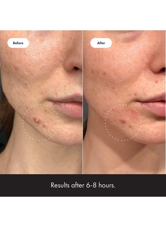 مايتي باتش رقعة هيرو كوزماتيكس غير المرئية من مايتي باتش - رقعة نهارية من الهيدروكولويد لعلاج حب الشباب والبثور، ملصقات رقيقة للغاية للوجه والبشرة (24 رقعة متوسطة و15 رقعة صغيرة) - Image 4