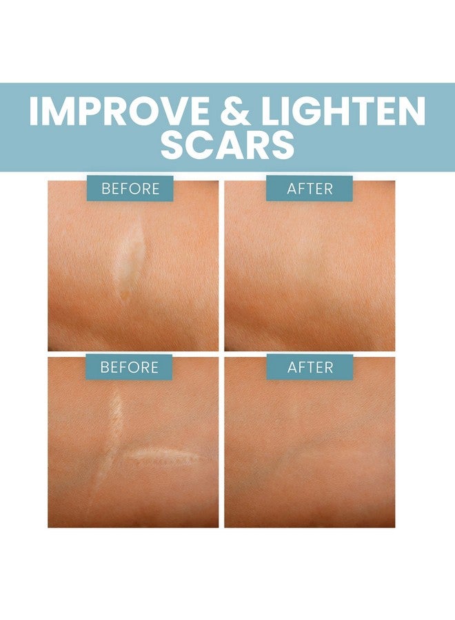 إيفا ناتشورالز شريط سيليكون طبي ناعم للندبات (1.6 بوصة × 120 بوصة) يقلل من ظهور تضخم القسم الجراحي على شكل حرف C ندبات الجدرة وندبات حب الشباب شريط ندبات السيليكون للندبات الجراحية ندبات السيليكون - Image 5