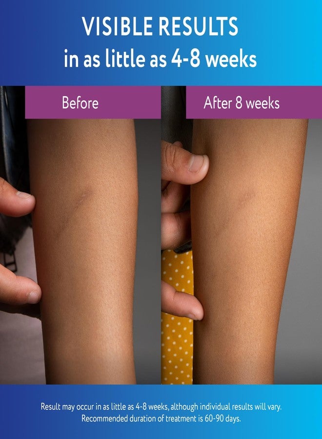 ScarAway Silicone Scar Gel, Helps Improve Size, Color & Texture of Hypertrophic & Keloid Scars from Injury, Burns & Surgery, Water Resistant, 10g (0.35 Oz) - Image 5