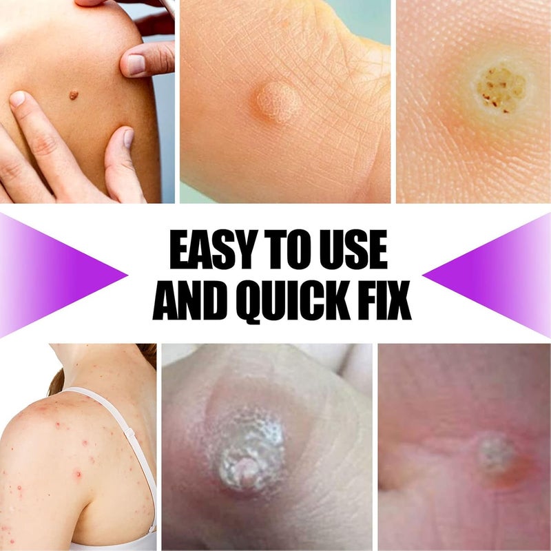comfrt 20ML Wart Removal Liquid, Safe Efficient Plantar Wart Remover, for Face Limbs Reproductive Organs and Soles, Painlessly Removes Plantar - Image 5