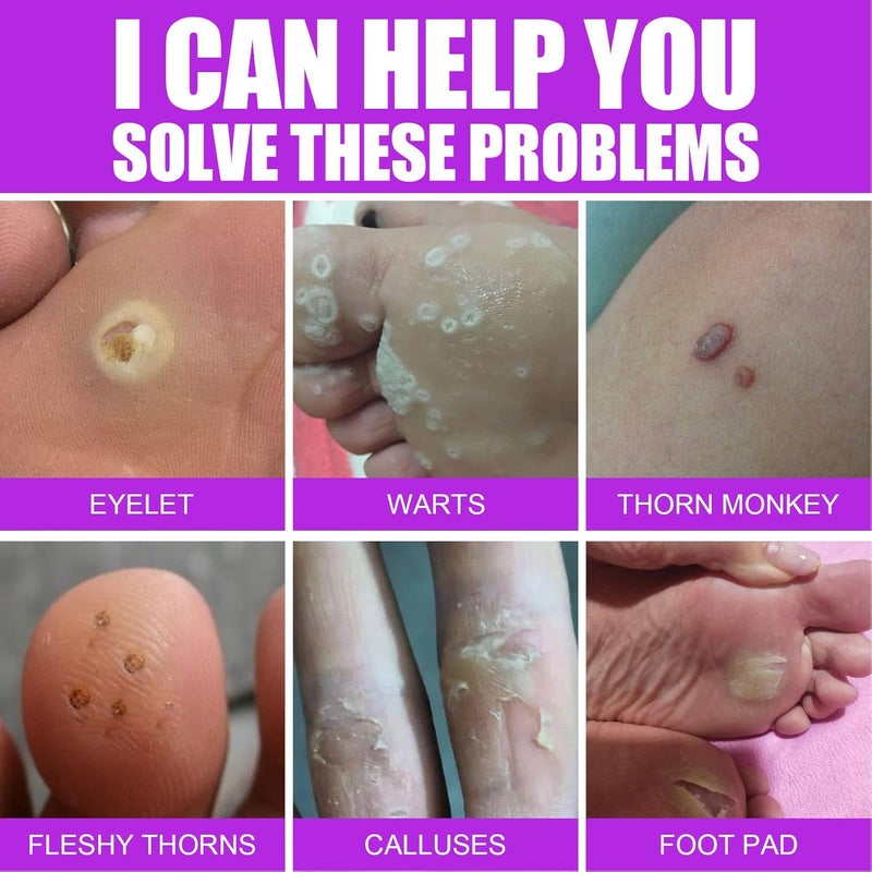 comfrt 20ML Wart Removal Liquid, Safe Efficient Plantar Wart Remover, for Face Limbs Reproductive Organs and Soles, Painlessly Removes Plantar - Image 3