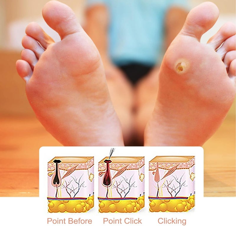 comfrt 20ML Wart Removal Liquid, Safe Efficient Plantar Wart Remover, for Face Limbs Reproductive Organs and Soles, Painlessly Removes Plantar - Image 4