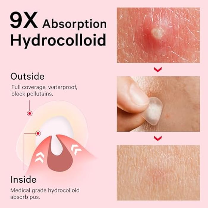 Sosky Pimple Patches for Face, Invisible Hydrocolloid Acne Patches, HSA Store Eligible Items, Zit Sticker for Face and Skin, Pimple Sticker for Covering Zits, Blemishes with Salicylic Acid 48 Count - Image 3