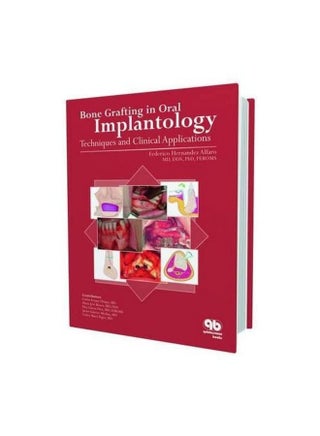 Bone Grafting in Oral Implantology: Techniques and Clinical Applications - pzsku/Z6F536EA626474729A72FZ/45/_/1724847759/515dd641-bad1-4245-be14-af05cdb6ca0e