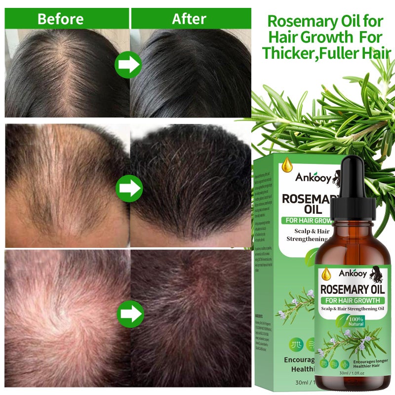 Ankooy 3 Pack Rosemary Oil for Hair Growth,Rosemary Hair Growth Oil,Strengthening Oil for Dry Damaged Hair,Hair Loss Treatment & Thickens Hair,Scalp Care Promotes Hair Thickness for Men Women - Image 3