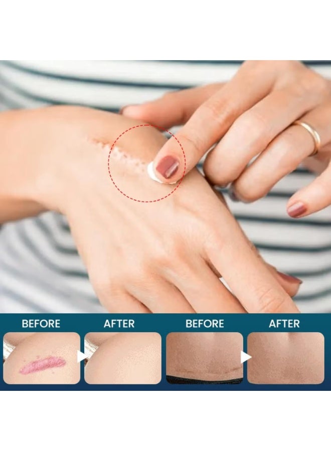 سوميفون كريم إزالة الندبات 20 جم ، كريم العناية بالبشرة من اللافندر ، كريمات إصلاح الندبات للحروق الحروق علامات التمدد ندبات حب الشباب والندبات القديمة تسريب اللافندر المهدئ لاستعادة الجلد - Image 4