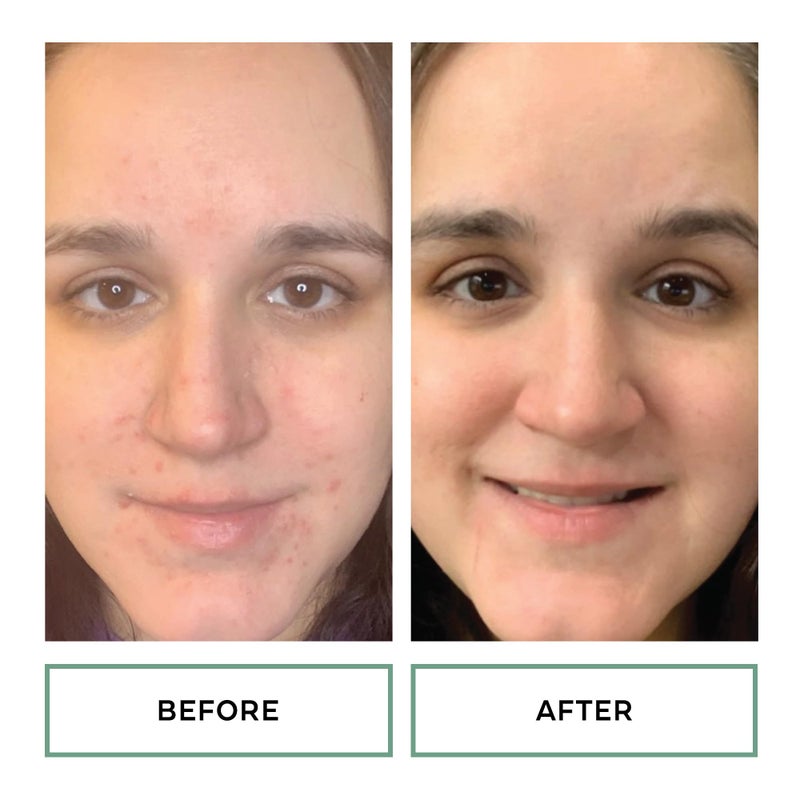 Replenix Gly-Sal Clarifying Acne Pads, 60 Count, Medical-Grade Glycolic Acid & 2% Salicylic Acid Exfoliating Pads for Acne-Prone Skin, Help Clear Blemishes & Refine Pores, Non-Oily - Image 4