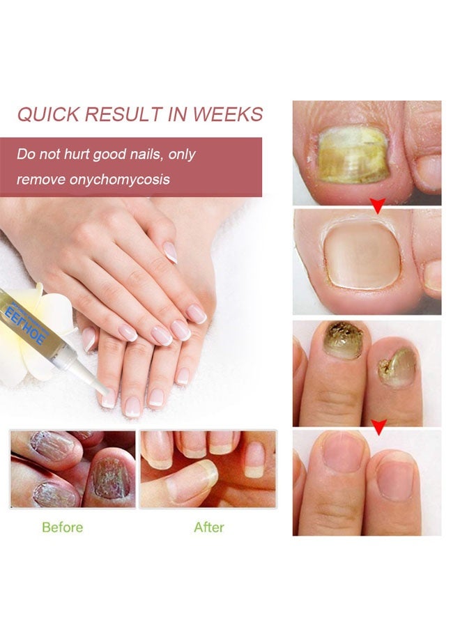 إيلهو محلول علاج فطري، قلم تصليح أظافر مضاد للفطريات، سائل عناية بفطريات الأظافر للعناية اليومية باليدين والقدمين، يرطب وينعم الأظافر السميكة، يصلح تلف الأظافر، 3 مل - Image 5