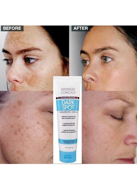 Advanced Clinicals Dark Spot Correcting Cream - 8 Fl Oz (237 Ml), Formulated With Glycerin & Stearic Acid