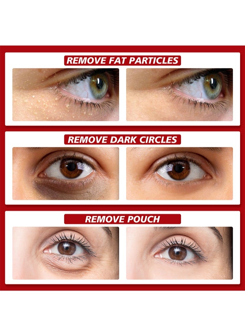 2 Pieces Of Milia Removal Essential, Treats Miliary Spots, Reduces Milia And Sebaceous Glands