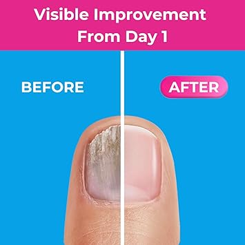 Excilor Fungal Nail ULTRA Extra Strong Treatment Extensive or Persistent Infections Clinically Proven No Filing Day 1 Visible Improvement Nail Polish Compatible WaterResistant 30ml - Image 5