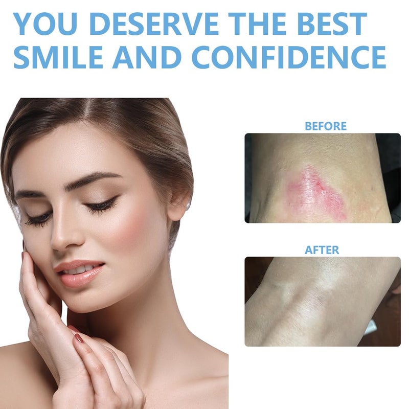 LINXIU Silicone Scar Sheets 16 x 120 Silicone Scar Tape Roll Removal Scar Patches for Surgical Scars Keloid Clear - Image 5