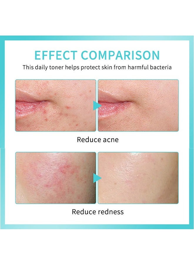 lakerain Daily Rescur Facial Spray - Hypochlorous Acid Face and Skin Spray,Facial Toner with Pure Hypochlorous,Face and Skin Renew Toner Spray,Moisturising Spray for Sensitive Skin 30ML  - Image 5