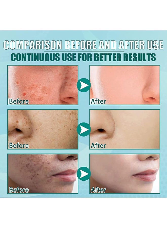 Beauenty Nicotinamide Whitening Freckle Cream, Whitening Freckle Cream, Dark Spot Remover For Face Hyperpigmentation Treatment, Dark Spot Corrector For Face, Smooth Skin Moisturizer Cream 50g - Image 5