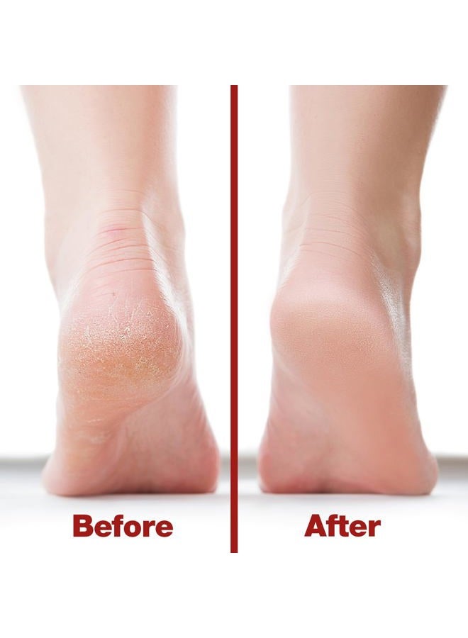 Probelle Double Sided Multidirectional Nickel Foot File Callus Remover - Immediately Reduces calluses and Corns to Powder for Instant Results, Safe Tool (Red) - Image 4