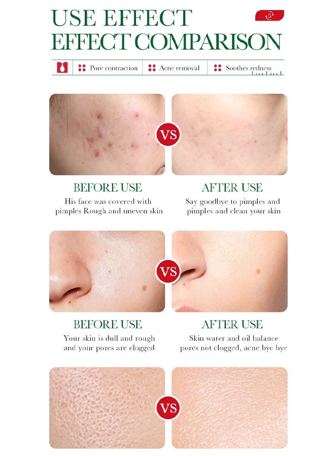 BIOAQUA Salicylic Acid Acne Removal Essence -  Oily Skin | Helps Improve the Appearance of Enlarged Pores, Pimples, Blackheads and Uneven Texture, Moisturizing and shrinking Essence, 35 ml - Image 3