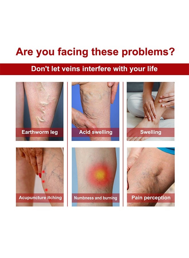 SOUTH MOON Varicose Veins Cream，Relieve Tired Legs Relieve Dilated Capillaries Minimize Varicose &Spider Veins ​Relief Cream 20g  - Image 4