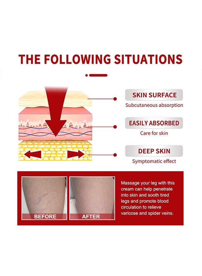 SOUTH MOON Varicose Veins Cream，Relieve Tired Legs Relieve Dilated Capillaries Minimize Varicose &Spider Veins ​Relief Cream 20g  - Image 5