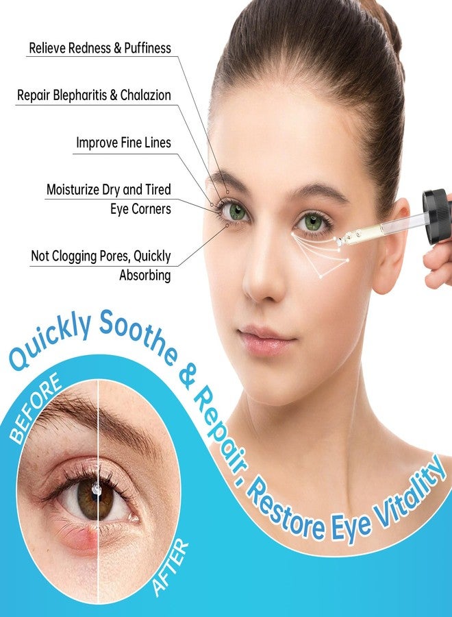 MIZEEYE Eye Serum For Chalazion & Blepharitis Treatment, 2 PCS Chalazion Remover For Eyelid Treatment, Eyelid Serum With Avocado Oil, Sea Buckthorn Oil & Caffeine, Relieve Puffiness and Eye Fatigue - Image 2