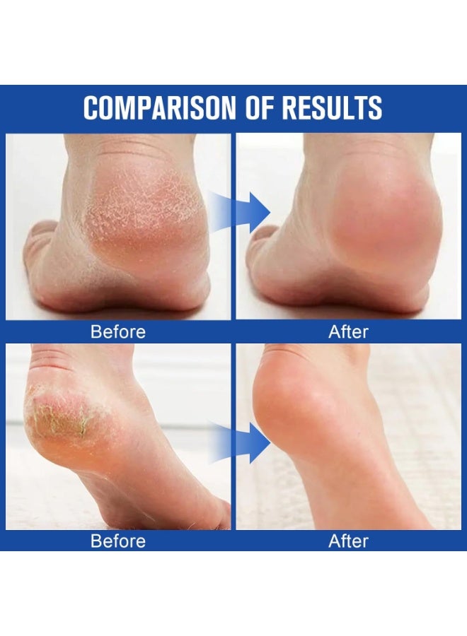 Urea Cream 60 Percent for Feet with 2% Salicylic Acid 2 Pack, Urea Foot Cream for Cracked Heels and Dry Skin, Deep Moisturizing, Callus Remover and Soften, Cracked Heel Repair Cream, Foot Moisturiser - Image 3