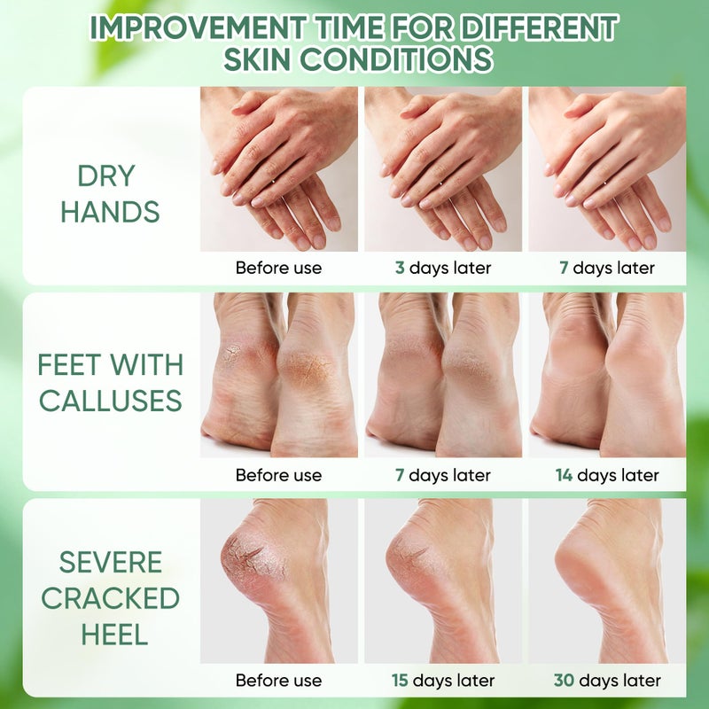 Grocerism Urea Cream 50 Percent for Feet with Coconut 5.29 oz || Foot & Hand Cream Maximum Strength with 2% Salicylic Acid, Tea Tree and Aloe Vera for Deep Moisturizing and Callus Removing (Upgraded Formula) - Image 4