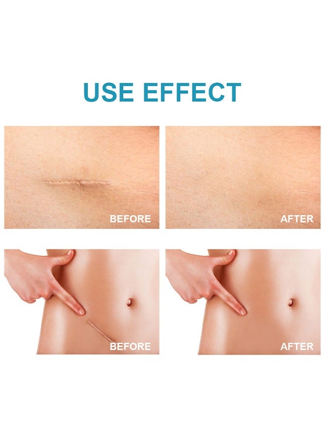 لينماي ندبة يختفي-الطبية الصف سيليكون ندبة كريم جل إزالة ندبة متقدمة للندبات الجراحية علامات التمدد إصابة حب الشباب الحروق الجدرة الضخامي الندوب القديمة والجديدة - Image 5