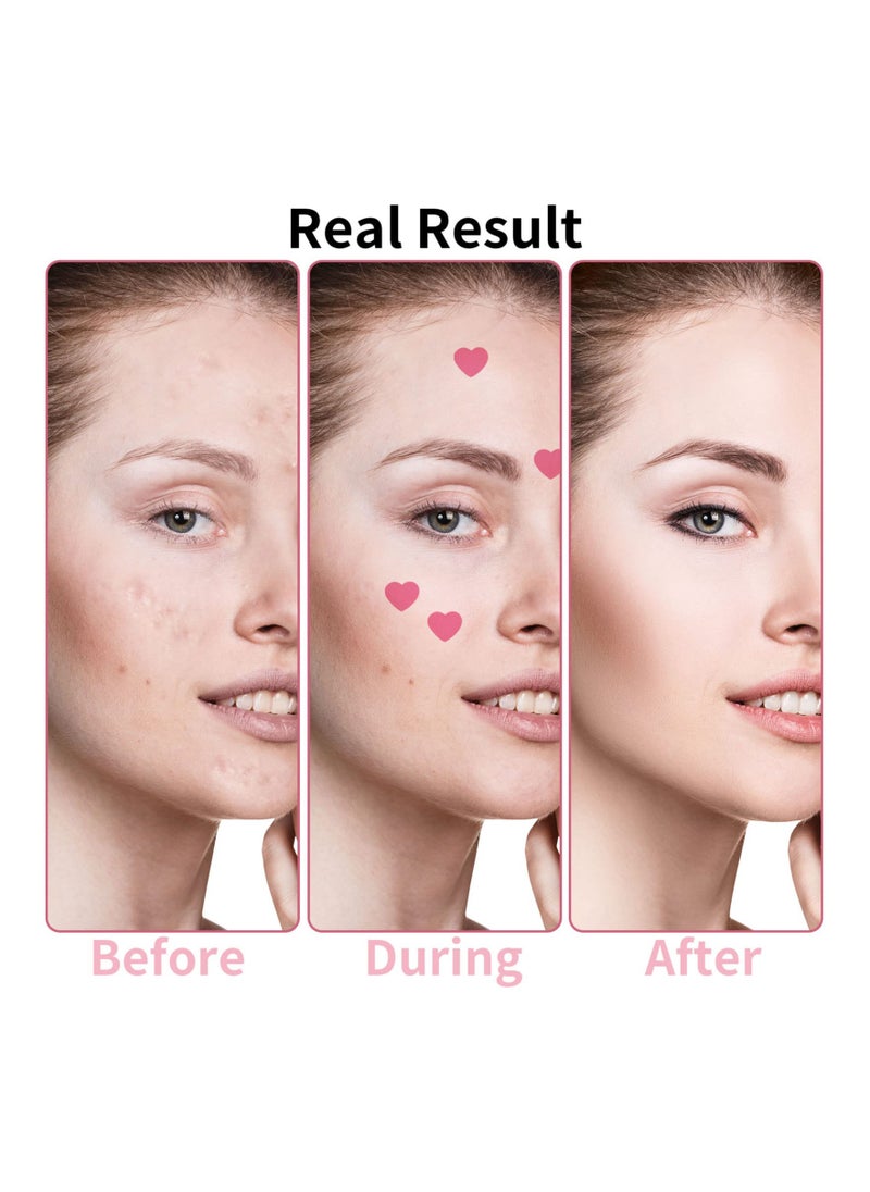 SYOSI Heart-Shaped Pimple Patches for Acne Treatment, Love Heart Acne Spot Patches Pimple Solution Pink Love Heart Patches Spot Patches  with Niacinamide and Hyaluronic Acid for Moisturizing, Blemish Spot  - Image 5