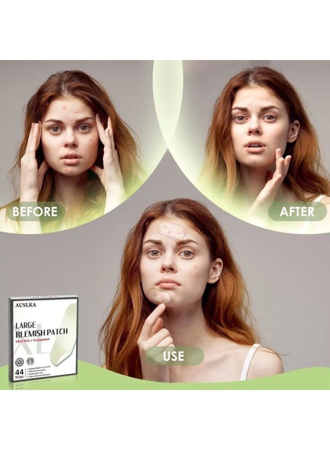 AUSLKA Large Blemish Acne Pimple Patches - 44 Strips, Hydrocolloid Spot Dots - Suitable For Larger-area Outbreaks - Image 3