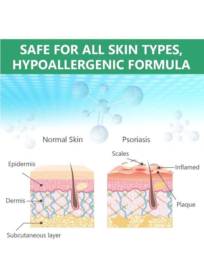 هيلموسز الصدفية كريم عشبي 20G ، كريم الصدفية ، كريم الجسم الاكزيما ، موس العلاج ، علاج الحكة الجلدية - Image 4