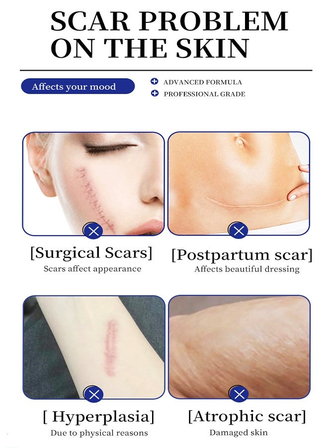 MOIKA Silicone Scar Cream,Scar Gel,Silicone Scar Gel,Advanced Scar Gel,Scar Removal Cream for Surgical Scars,Burn,Acne,Stretch Mark,Keloid Bump - Image 4
