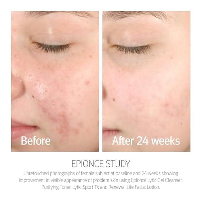 Epionce Purifying Toner – Acne & Blackhead Control Toner for Face & Body | Removes Dirt, Oil & Makeup | Willow Bark, Cucumber & Menthol | Dermatologist-Developed Skincare - Image 3