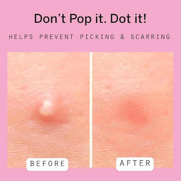 Dot Pimple & Zit Patches for Face – All-Natural Custom Triple-Action Formula Absorbs, Clears & Brightens Acne Spots with Hydrocolloid, Vitamin C, Tea Tree Oil & Salicylic Acid (8, 10, 12 mm, 76 ct) - Image 3