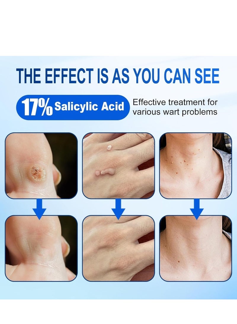 REINREUDE Wart Remover Serum 30ML Herbal Ingredients Safe Body Warts Treatment for Acne Moles Scar Wart Treatment Warts Remover for Face Body Warts Remover Gel Cream Ointment  - Image 2