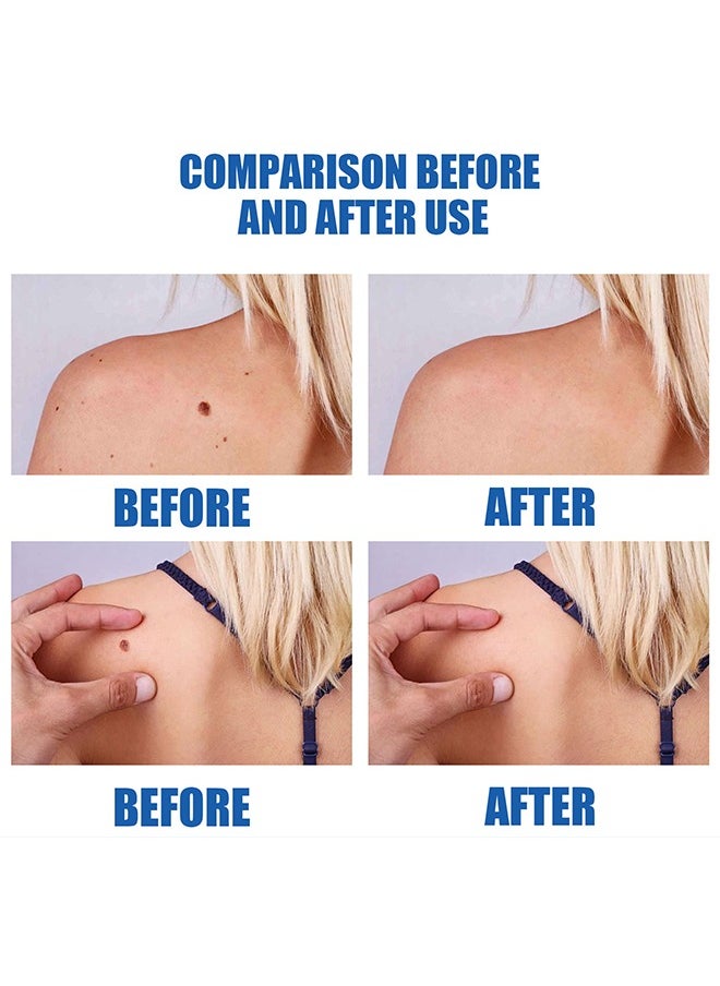 EELHOE - Warts Removal Pen - Remove Body Skin Tags Lighten Flesh Mole Pen - Hands, Feet, Face, Neck Flesh and Skin Tag Removal Pen - Repair Smooth Skin, Deep Cleansing Skin Care Gram Wart Removal Pen - Image 1