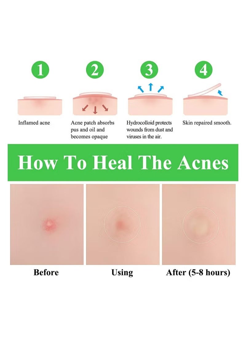 Breylee 66 Patchs Acne Pimple Patch Transparent  - Image 5