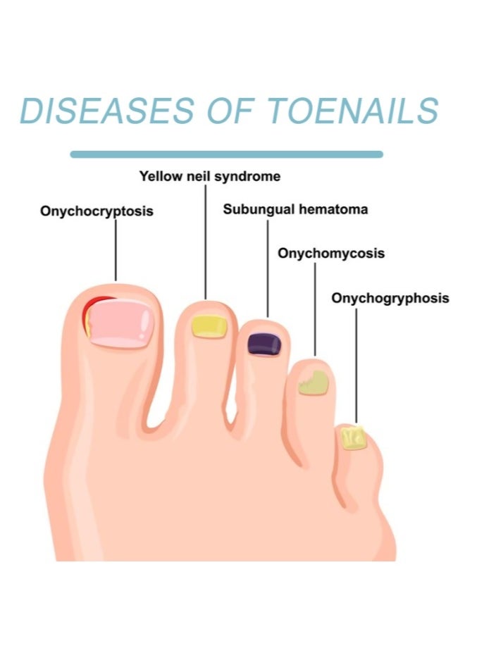 SOUTH MOON Nail Fungal Cleaning Laser Relief Device Toenails Paronychia Treatment Onychomycosis Care Device  - Image 4