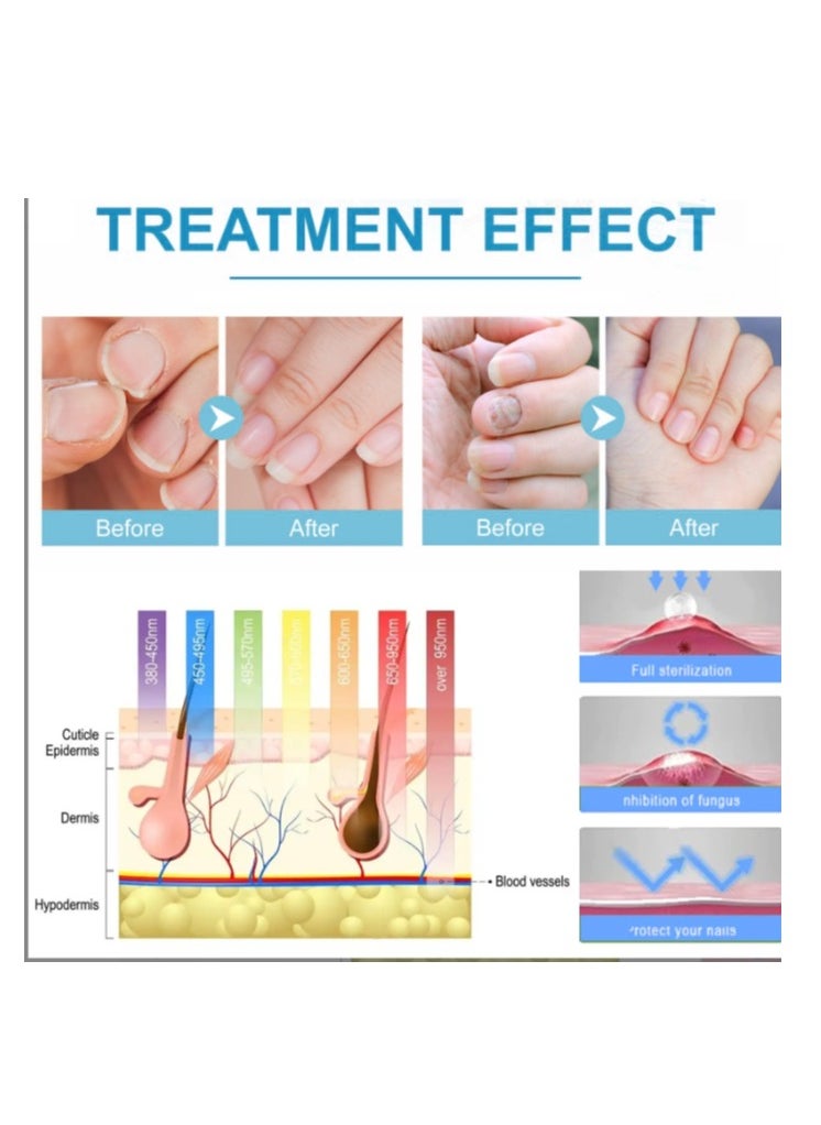 SOUTH MOON Nail Fungal Cleaning Laser Relief Device Toenails Paronychia Treatment Onychomycosis Care Device  - Image 2