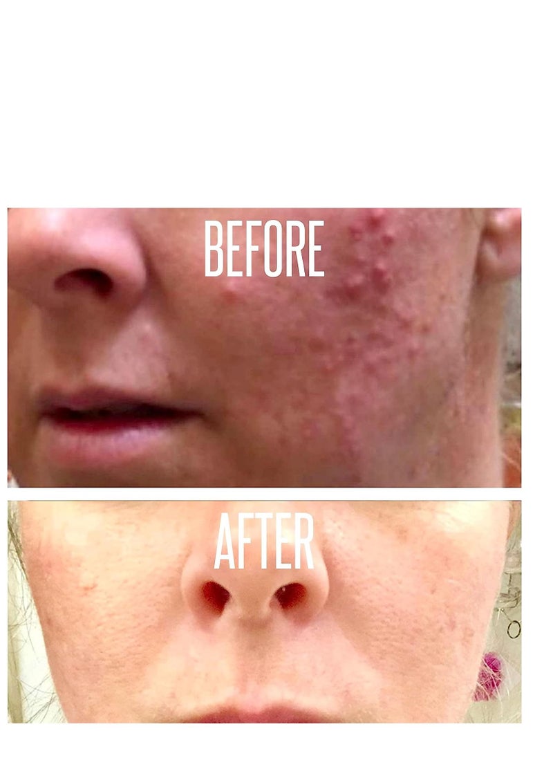 Divine - Glycolic Acid Peel 70% Professional Chemical Peel for Face at Home Intense Alpha Hydroxy Acid Skin Peel For Acne Scars Collagen Boost Wrinkles Fine Lines - Liquid Exfoliant for Face Peel Mask - Image 1