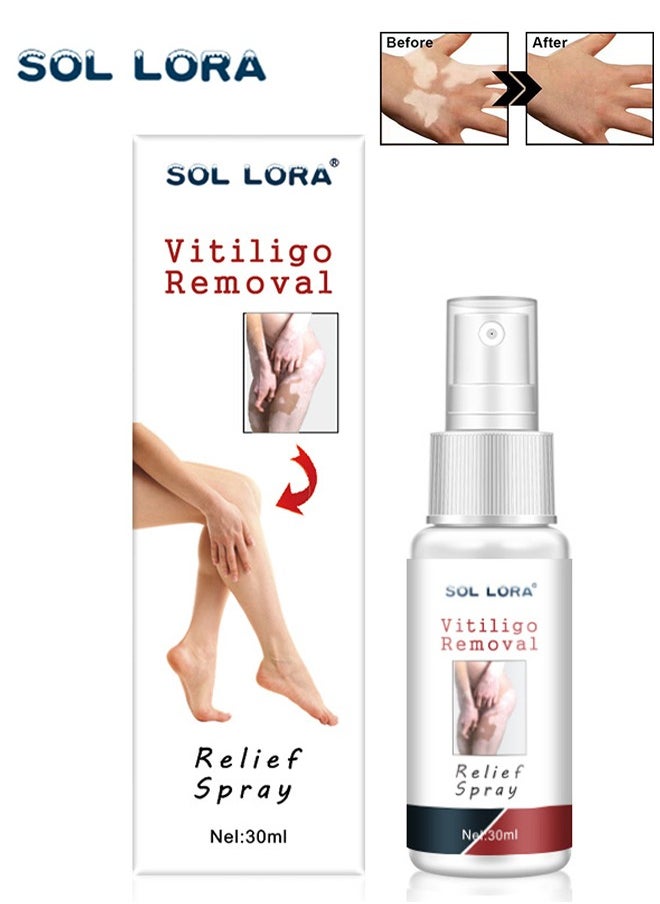 SOL LORA Vitiligo Removal Relief Spray，Promote Melanin Recovery,Reduces White Spots on Skin and Improve Skin Pigmentation,Vitiligo Care Spray（30ml） 
