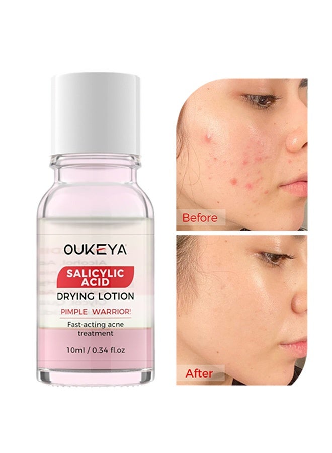 OUKEYA Acne Drying Lotion with Salicylic Acid – Double Acid Formula for Acne-Prone Skin, Oil Control, Redness Relief, Fade Marks – 29ml - Image 1