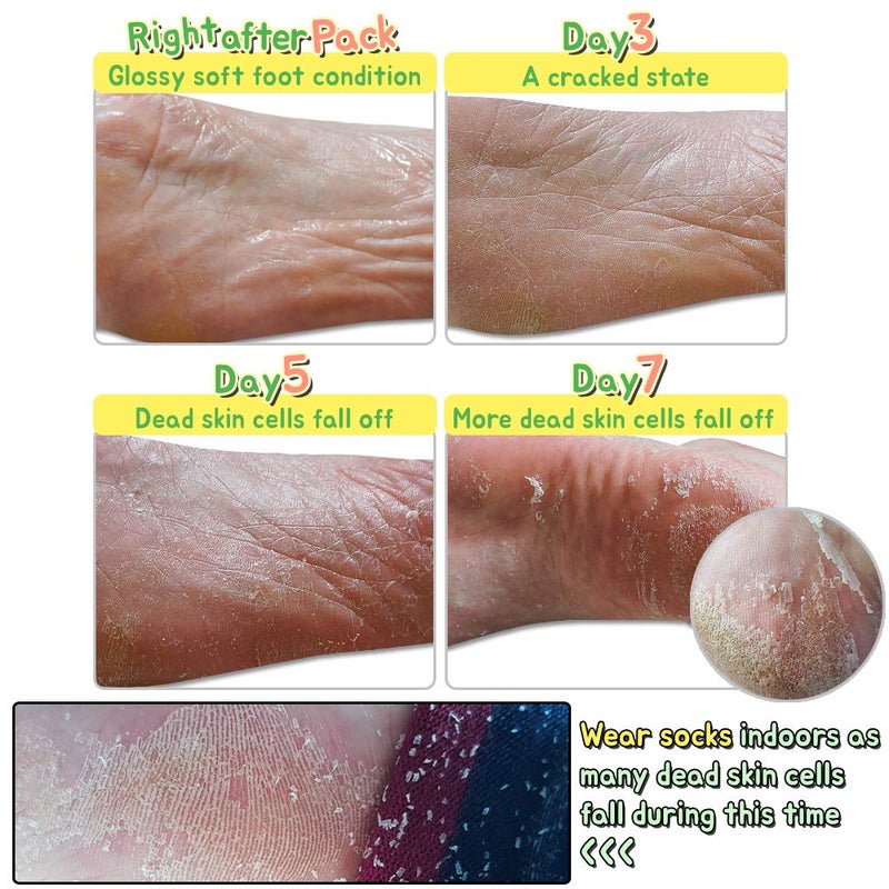 Elizavecca/Foot Peel /1 Foot Pack 2 Pairs Foot Mask - Boots for Exfoliating/foot pack review/foot pack before and after - Image 5