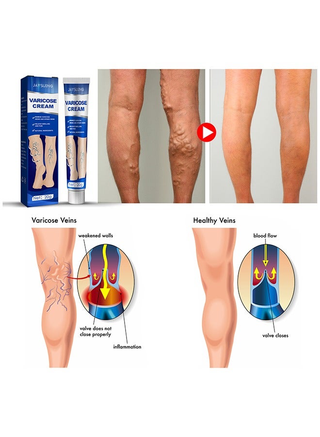 Jaysuing Varicose Veins Cream, Relief Phlebitis Angiitis 100% Natural Ingredients Added Eliminate The Appearance Of Varicose Veins - Vein Inflammation Treatment For Men And Women 20G - Image 4