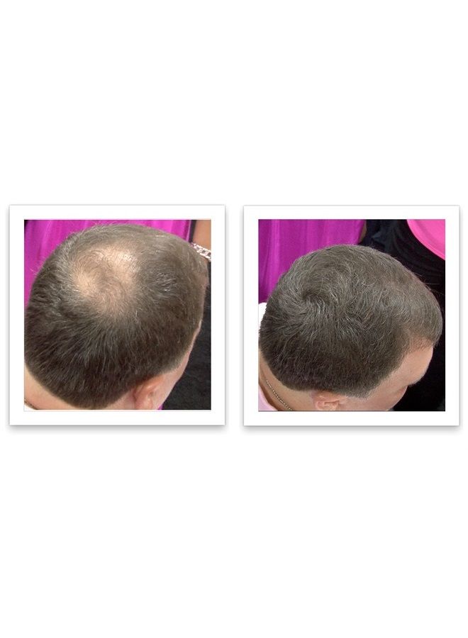 Caboki All-Natural Hair Building Fiber. Make Thin Hair Look 10X Fuller Instantly. Eliminate the Appearance of Bald Spot and Thinning Hair (30G, 90-Day Supply). Medium Brown