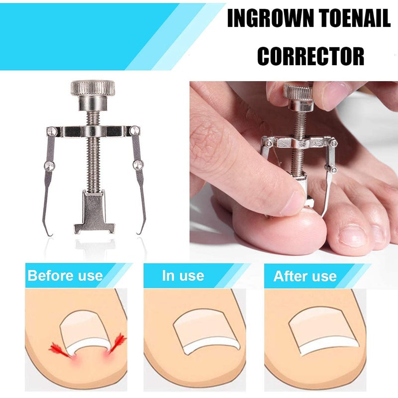 Dualeco Ingrown Toenail Tool Kit (9PCS), Professional Toe Nail Clipper Set for Ingrown & Thick Nail, Stainless Steel Ingrown Toenail Kit, Surgery Grade Manicure Pedicure Tool by Dualeco - Image 5