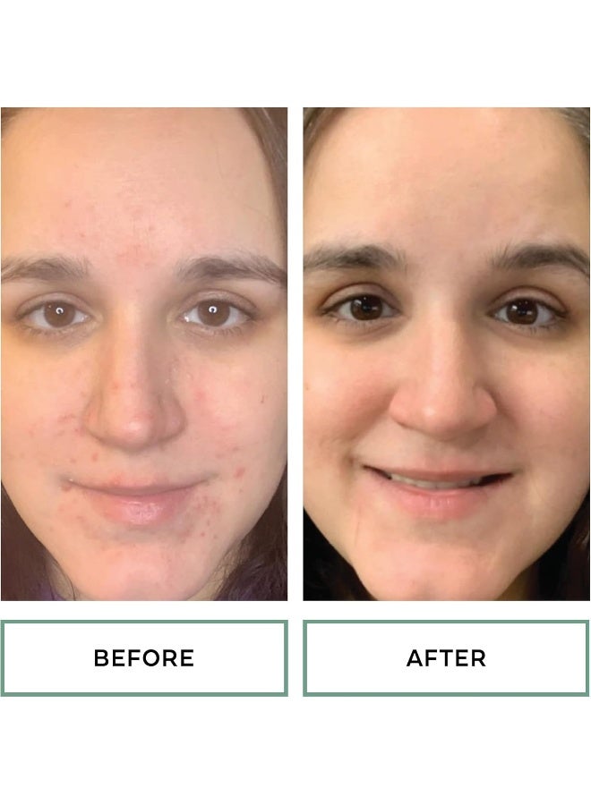 Replenix Acne Solutions Gly-Sal 10-2 Exfoliating Acne Pads With Glycolic Acid And Salicylic Acid, 60 Count - Image 4