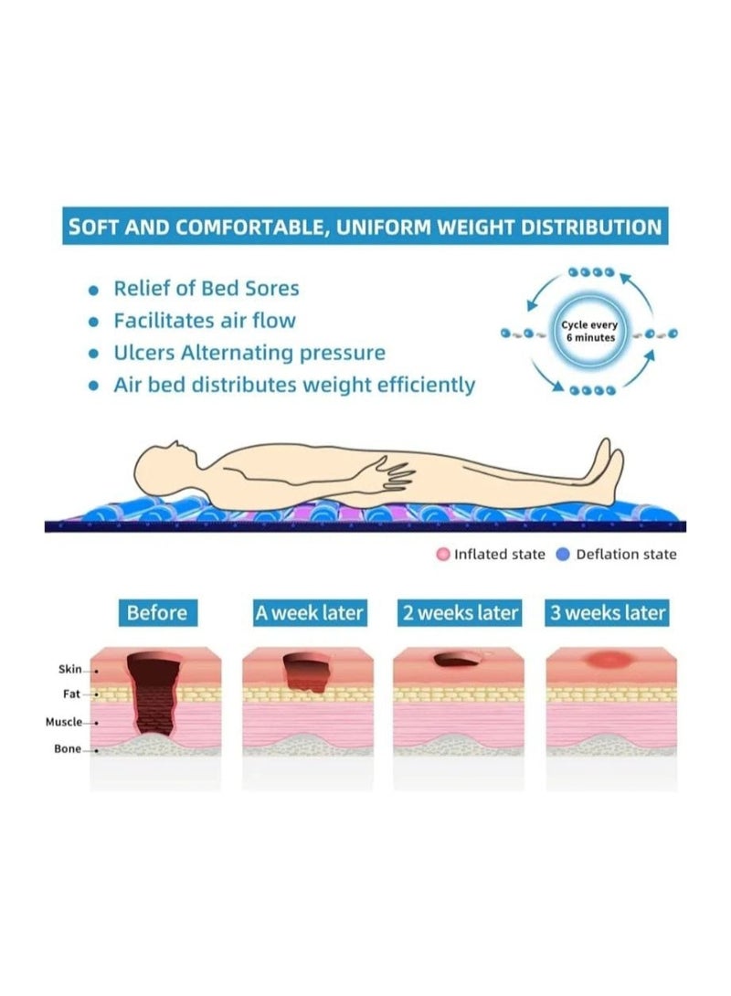 High Key Anti-irritant tubular air mattress for patients with bedsores; pain-relieving, inflatable; helps prevent bedsores. - Image 3