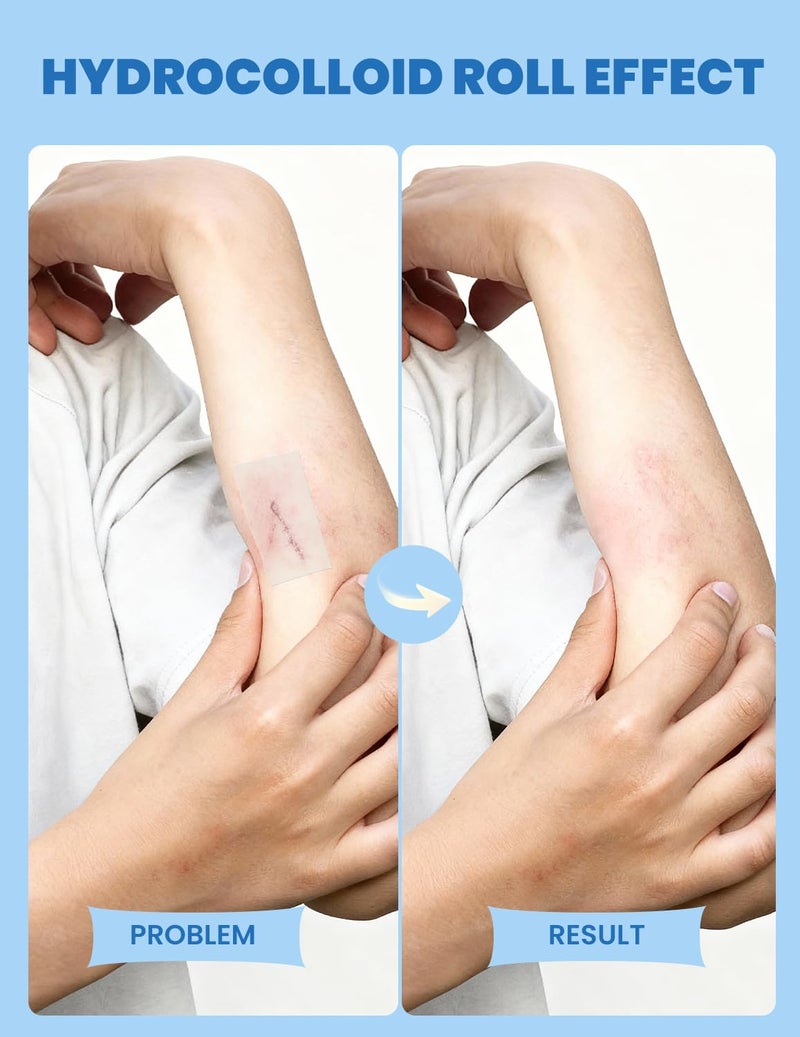 Dr. Zitacne لفافة هيدروكولود للعناية بالجروح وحب الشباب، لاصقة بثور قابلة للقطع، ضمادات هيدروكولود قابلة للتخصيص، مقاومة للماء، تمتص القيح، مرنة، نظيفة وسهلة الاستخدام، الإسعافات الأولية لحب الشباب، الجروح والبثور (2 بوصة × 4.9 قدم) - Image 3